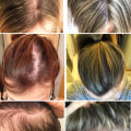 Pregnancy and Postpartum Hair Loss: Understanding Causes and Solutions