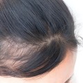 The Impact of Poor Diet on Hair Loss