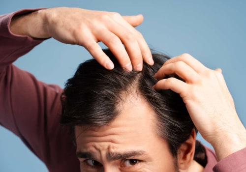 Understanding Finasteride: A Comprehensive Look at Hair Loss Prevention and Treatment