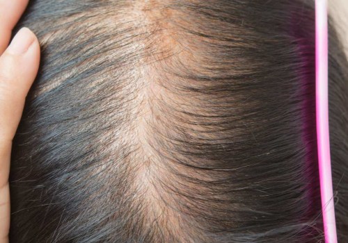 Iron-Deficiency Anemia and Hair Loss: Causes, Prevention, and Treatment