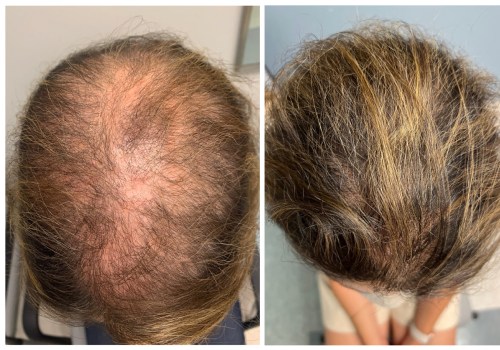Medical Treatments for Male Pattern Baldness: Stop the Loss and Regrow Your Hair